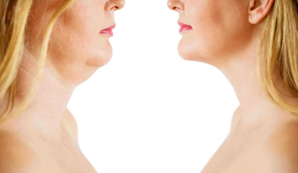 Double Chin treatment Northwood Hills before and after results