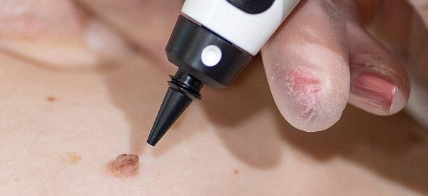 After Skin Tag Removal Northwood Hills