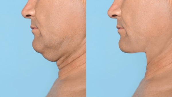 Which Non-Surgical Treatments Work Best for Jowls and Loose Skin Northwood Hills?