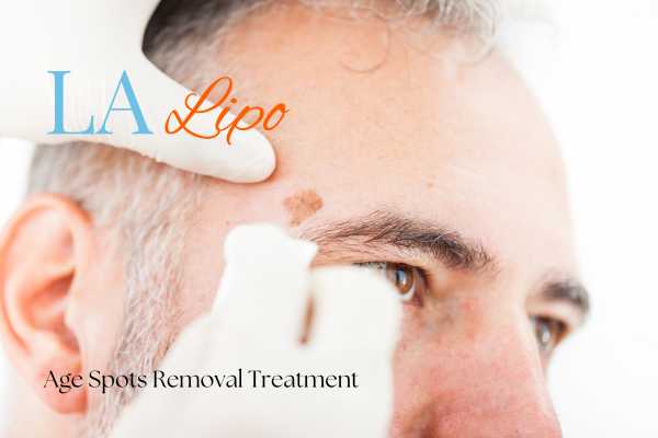 What Are the Most Effective Treatments for Age Spots Northwood Hills?