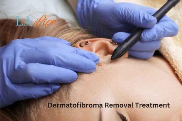 Dermatofibroma Removal Treatment Northwood Hills