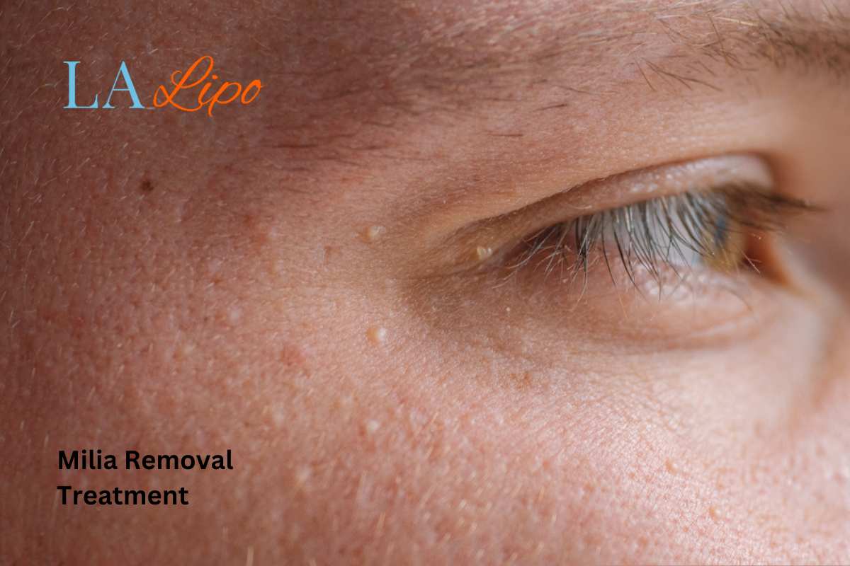 Cryopen Milia Removal: Is It the Easiest and Safest Option Northwood Hills?
