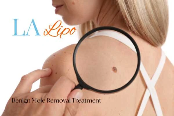 Why getting moles removed Northwood Hills can boost your confidence!