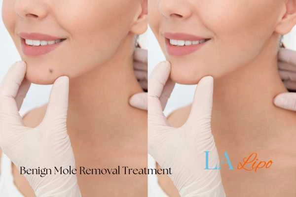 Woman's before and after results of being moles removal treatment Northwood Hills