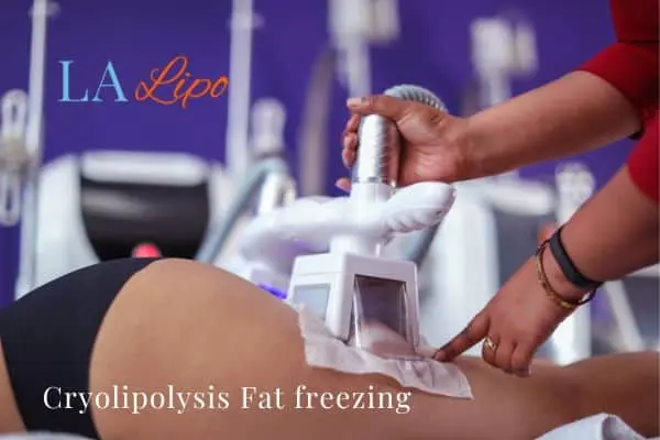 women getting fat freezing Northwood Hills