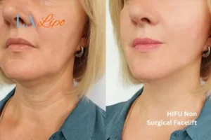 hi-fu for wrinkles Northwood Hills before and after results