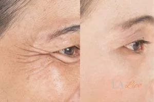 Before and after results of woman - HI-fu wrinkles reduction treatment Northwood Hills