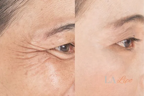 Before and after results of woman - HI-fu wrinkles reduction treatment Northwood Hills