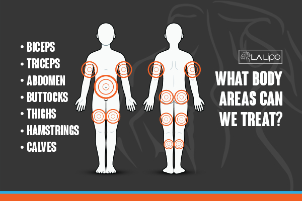 Graphic to show areas you can have LA-EMS Body Sculpting Northwood Hills treatment.