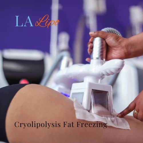 fat freezing - Cryolipolysis Northwood Hills