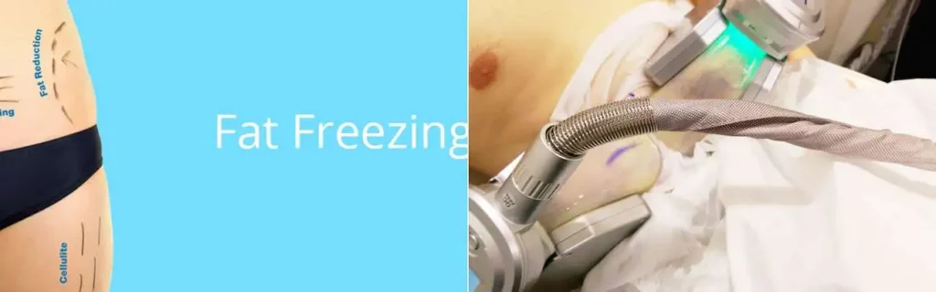 multi areas of a persons body having coolsculpting Northwood Hills treatment