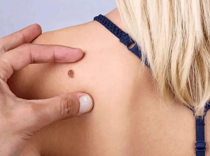 woman having mole removal Northwood Hills consultation before treatment.