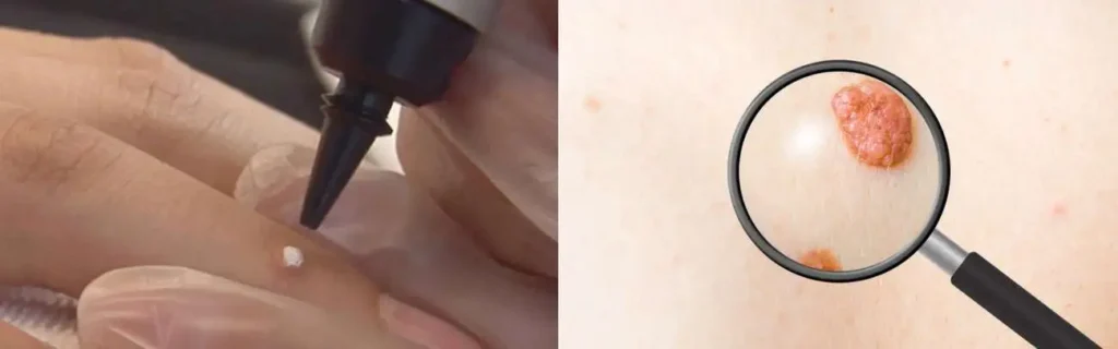 Cryopen for mole removal Northwood Hills - speak to our team today!