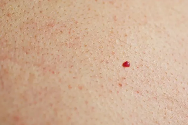 close up of a cherry angioma Northwood Hills