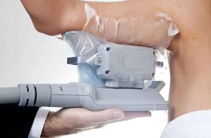 Picture of fat freezing Northwood Hills on the upper arms.
