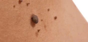 image of a skin tag Northwood Hills