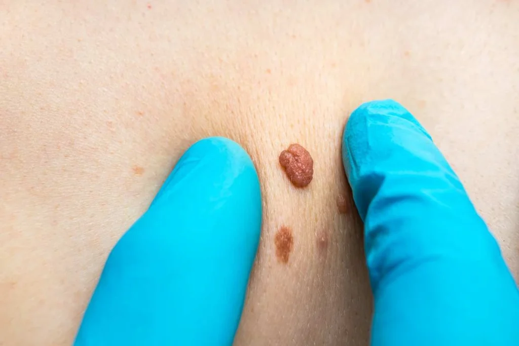 Consultant examining a skin tag Northwood Hills