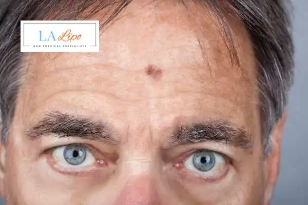 Solar Lentigo Removal Northwood Hills image of man with mark on his forehead