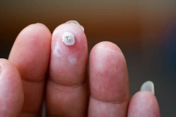wart on person finger - cryotherapy to treat from LA LIPO Northwood Hills