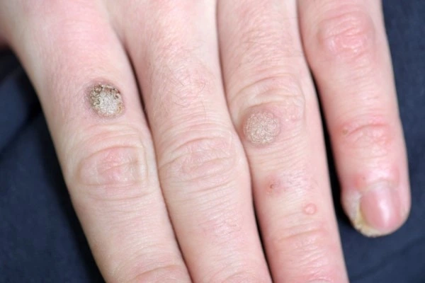 photo of warts on person hand - see wart removal Northwood Hills from LA LIPO