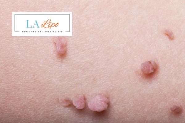 Does cryopen skin tag removal Northwood Hills hurt? Find out now call our team today!