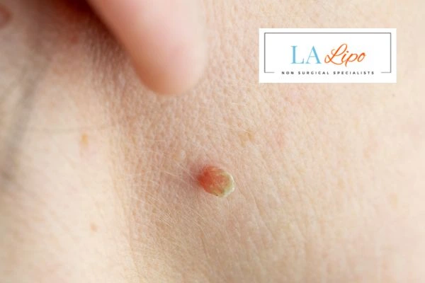 Book skin tag removal Northwood Hills today speak to our team now!