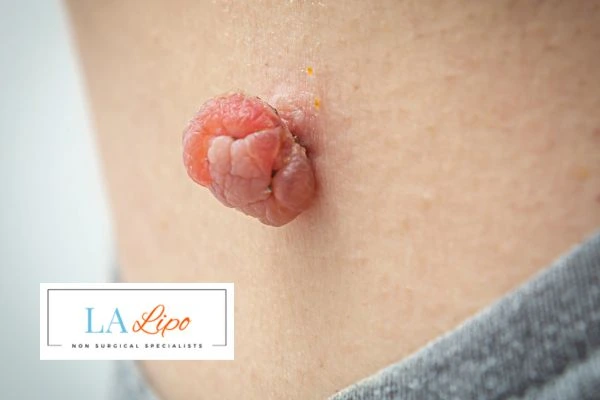 Interested in skin tag removal Northwood Hills? Concerned about the pain? Find out more today!