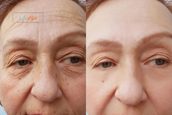 The powerful benefits of Morpheus8 Treatment Northwood Hills - Call Our team today!