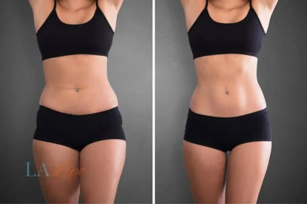 before and after results of non-surgical treatment to help a woman's body image and mental health Northwood Hills