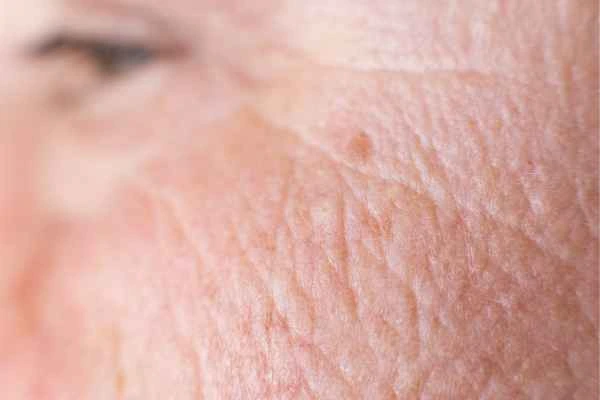 close up picture of a woman's face showing an age spot Northwood Hills
