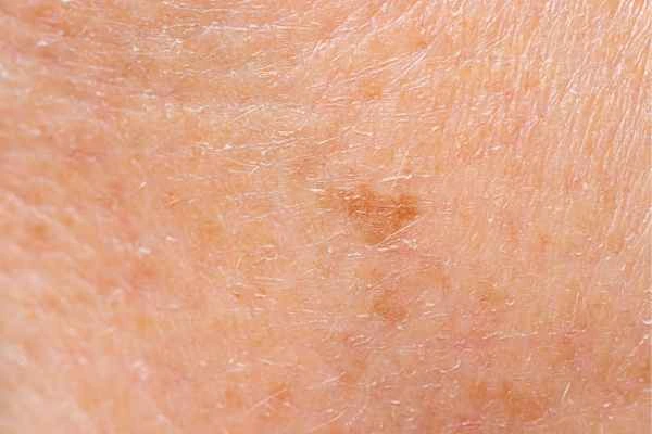 close up picture of age spots Northwood Hills