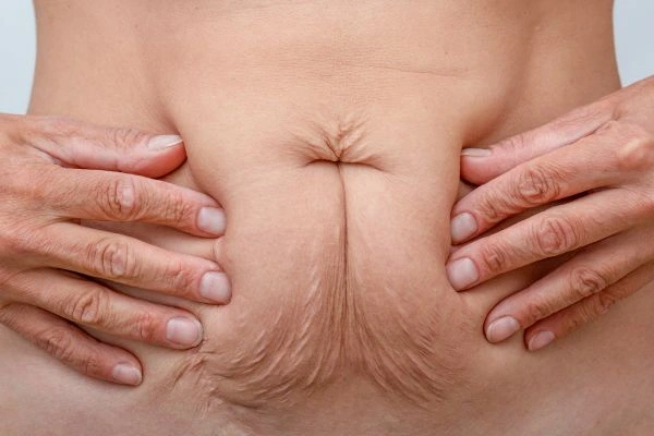 Should I Combine Diastasis Recti Treatment with Body Contouring for Better Results Northwood Hills?