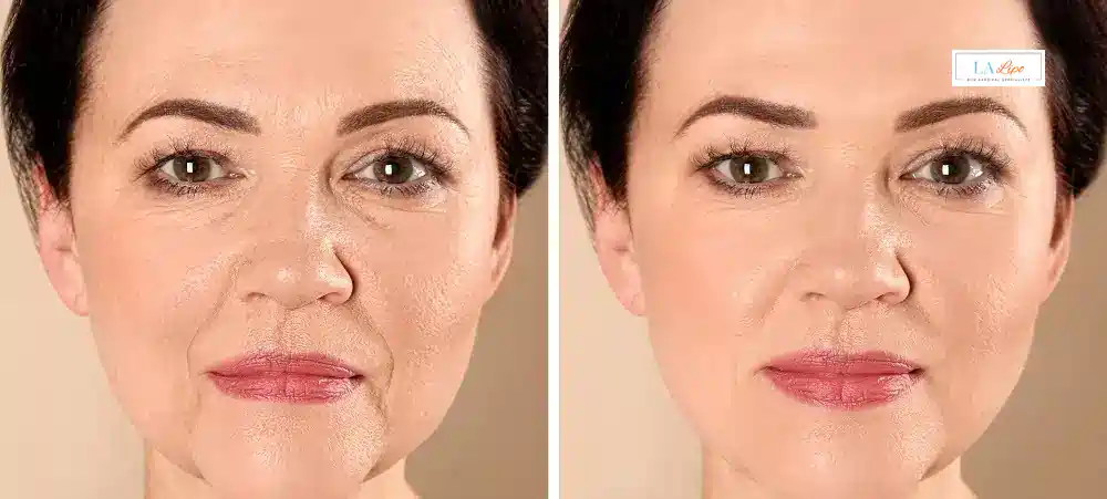 How Long Does It Take to See Results and How Long Do They Last Northwood Hills?