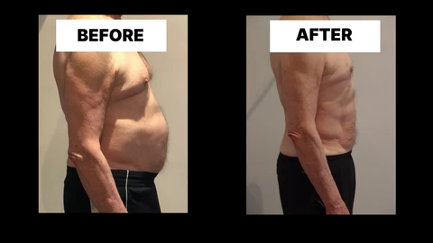 What Symptoms Can Diastasis Recti Cause in Men? Weak Core, Back Pain and Poor Posture Northwood Hills